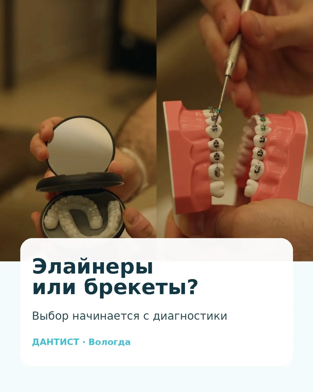 Элайнеры или брекеты: вопрос не только в ценеУ взрослых пациентов часто есть тревога: а...