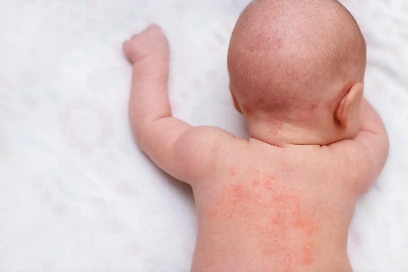 Потница у новорождённых: почему появляется и нужно ли её лечить? 👶🌡️