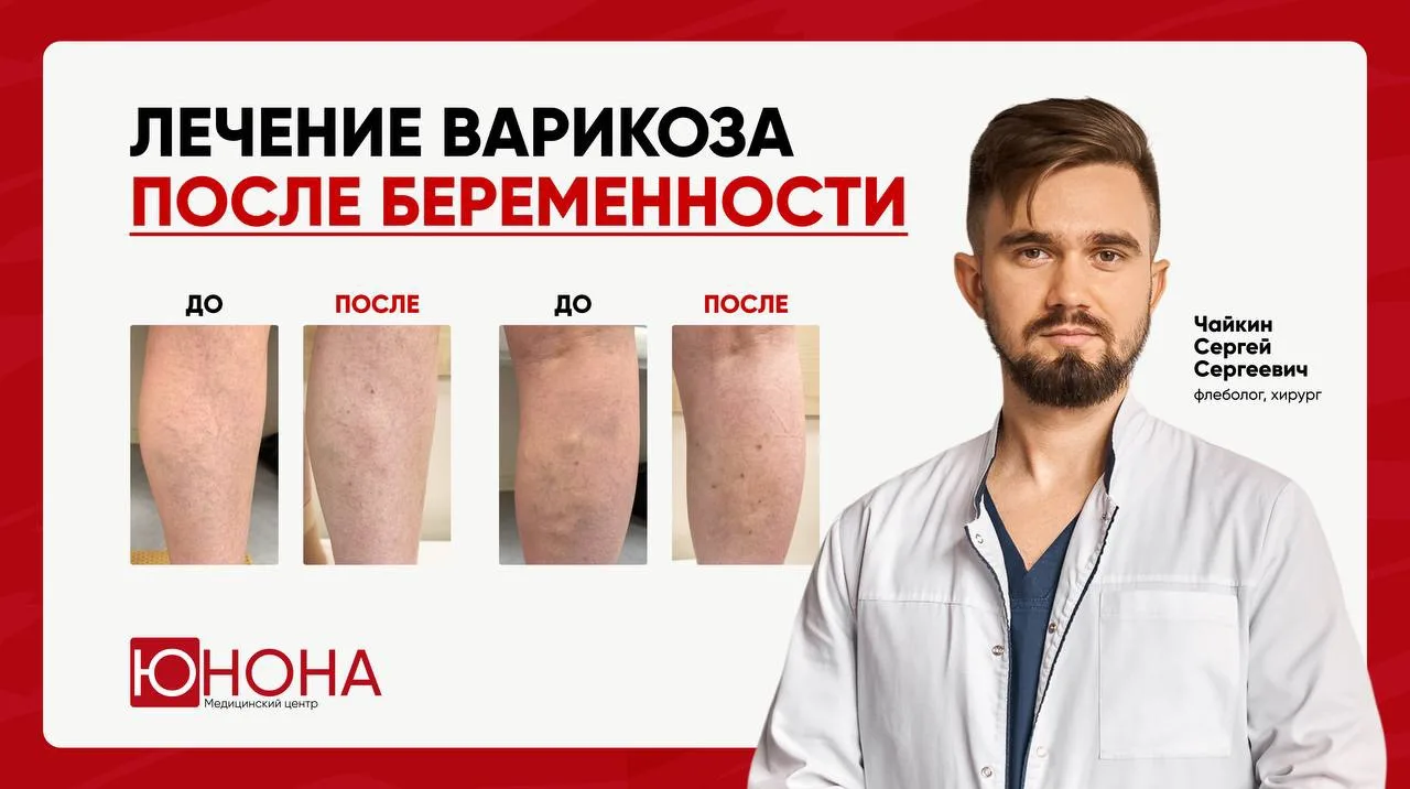Варикоз после беременности: лечение вен на обеих ногах у пациентки 33 лет 📌
⠀
К флебологу Чайкину С