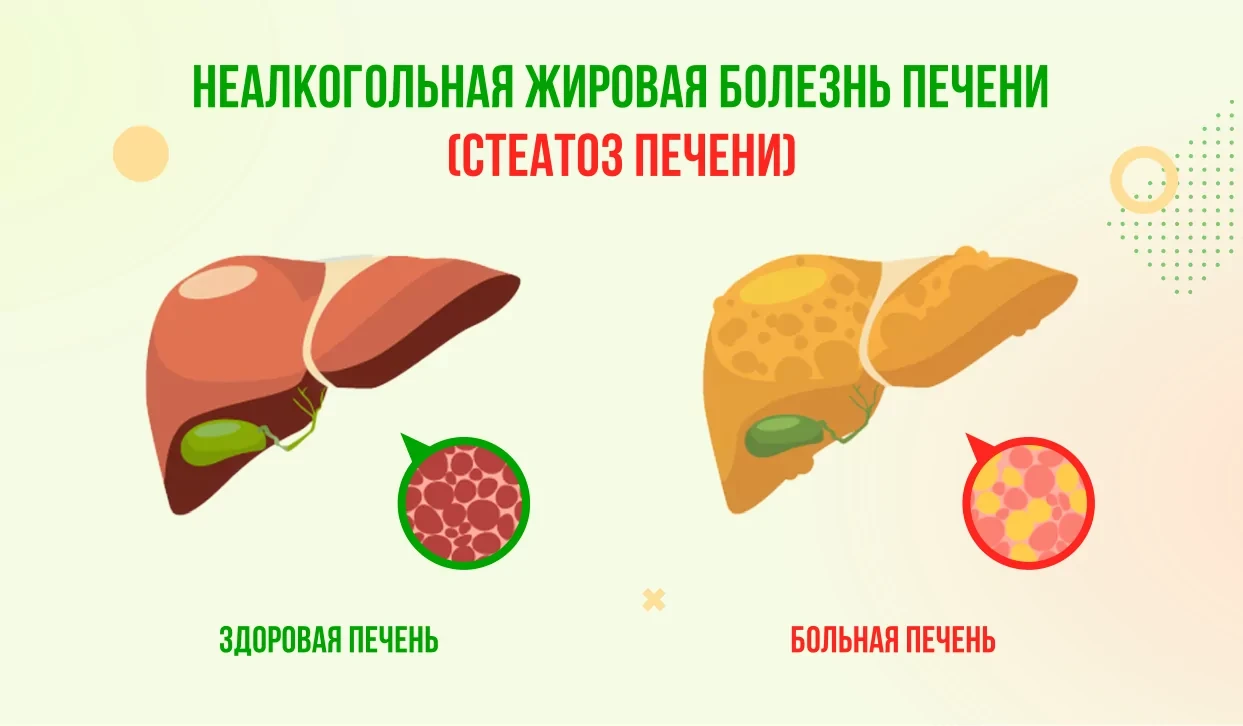 Жировая печень (стеатоз) — это состояние, при котором в клетках печени накапливается избыточный жир.
