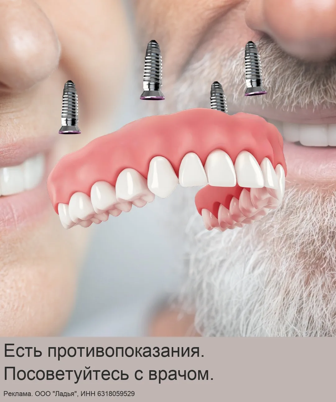 Имплантация всех зубов в клинике "Ладья" в Самаре!
