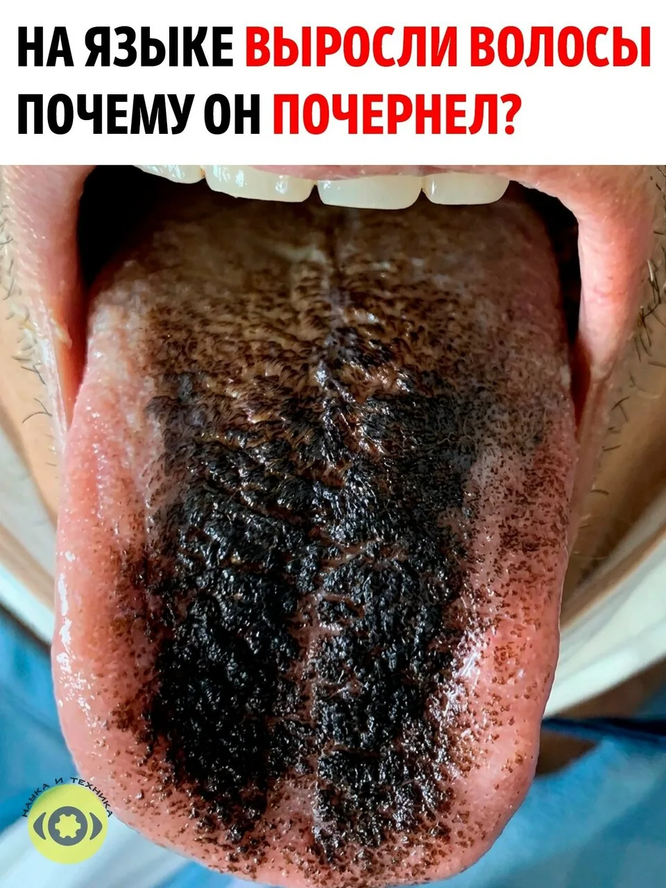 На первый взгляд кажется, что на языке действительно выросли чёрные волосы. Но волос та...