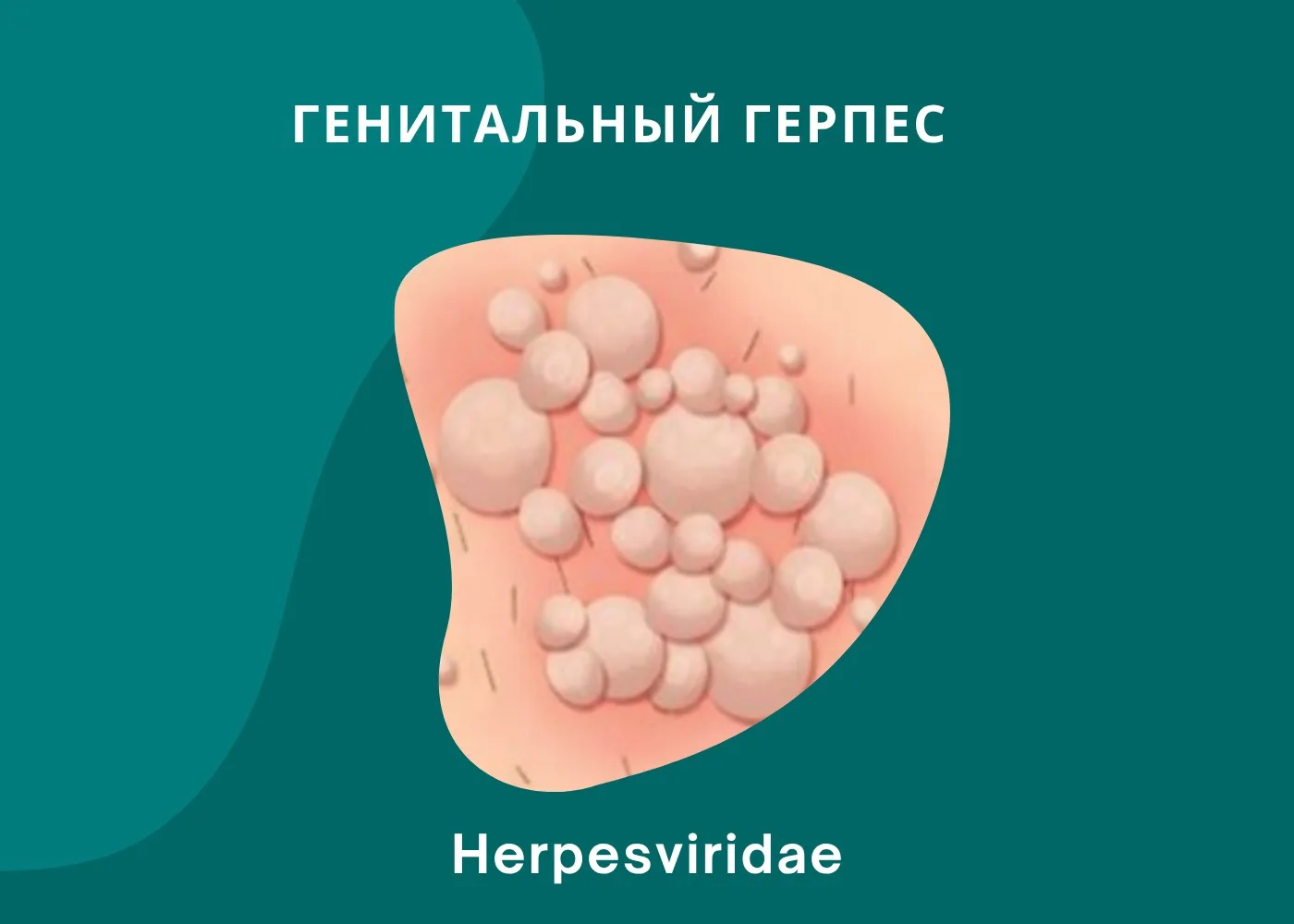 ГЕНИТАЛЬНЫЙ ГЕРПЕС🔴
Генитальный герпес — это хроническое рецидивирующее инфекционное заболевание, п