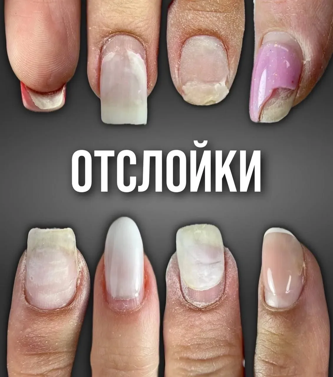 Отслойки 😖 Знакомая ситуация?