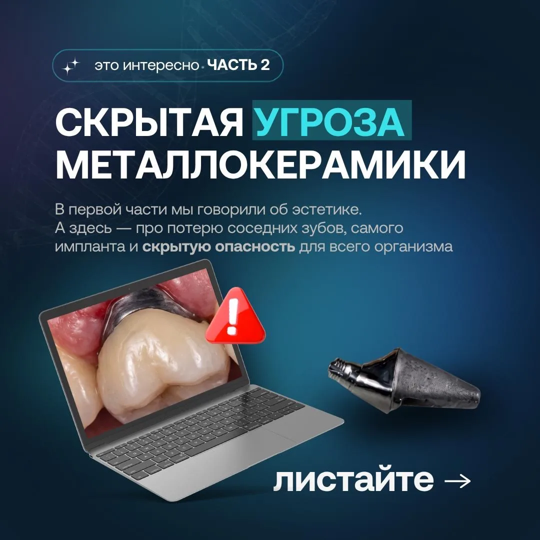 ❌Металлокерамика на имплантах: когда страдает не только эстетика