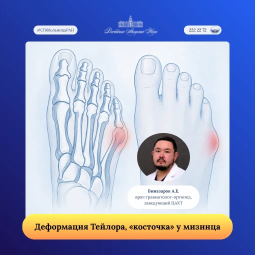 Деформация Тейлора: что делать, если «косточка» у мизинца мешает ходить