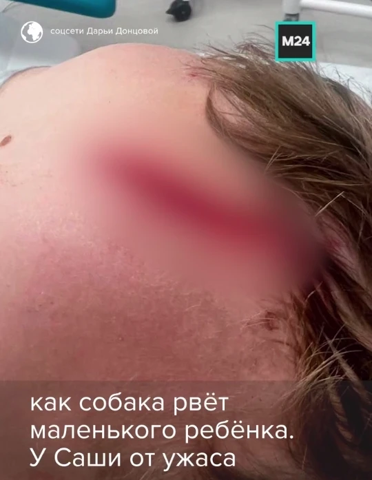 🐕 Внук Дарьи Донцовой пострадал после нападения собаки в Одинцовском округе