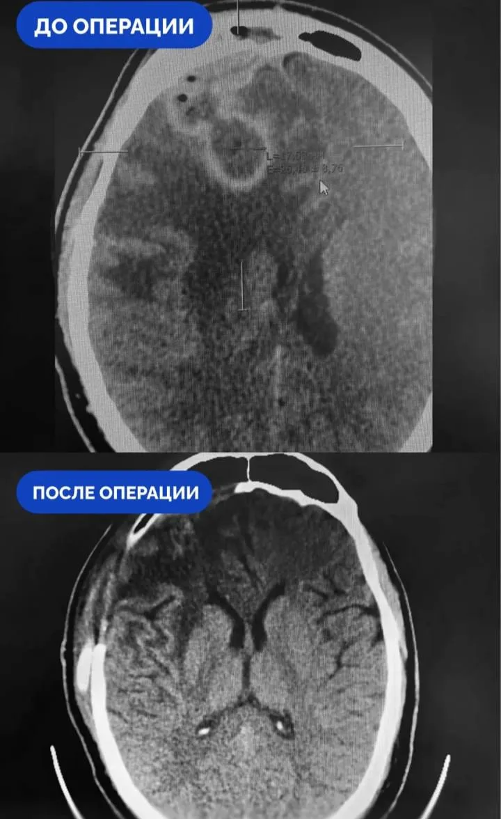 ⚡️ Четыре месяца самолечения насморка закончились для 21-летнего сургутянина абсцессом ...