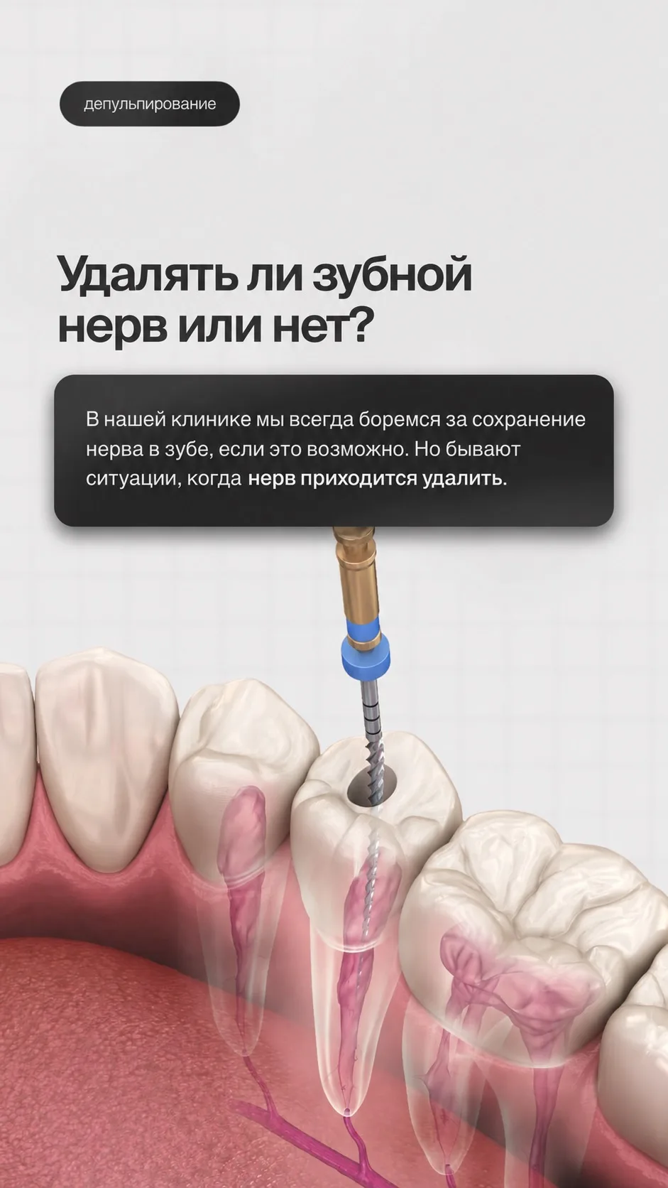 📌 ПОКАЗАНИЯ К УДАЛЕНИЮ НЕРВА ЗУБА
