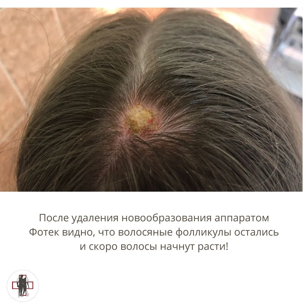 15 ЛЕТ! 15 долгих лет моя пациентка выращивала на своем теле это новообразование!