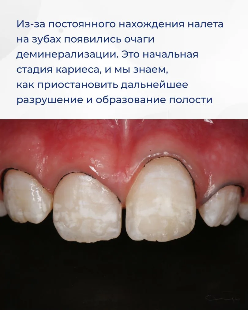 Недостаточно тщательная домашняя гигиена может привести к множественному поражению зубов. Именно это