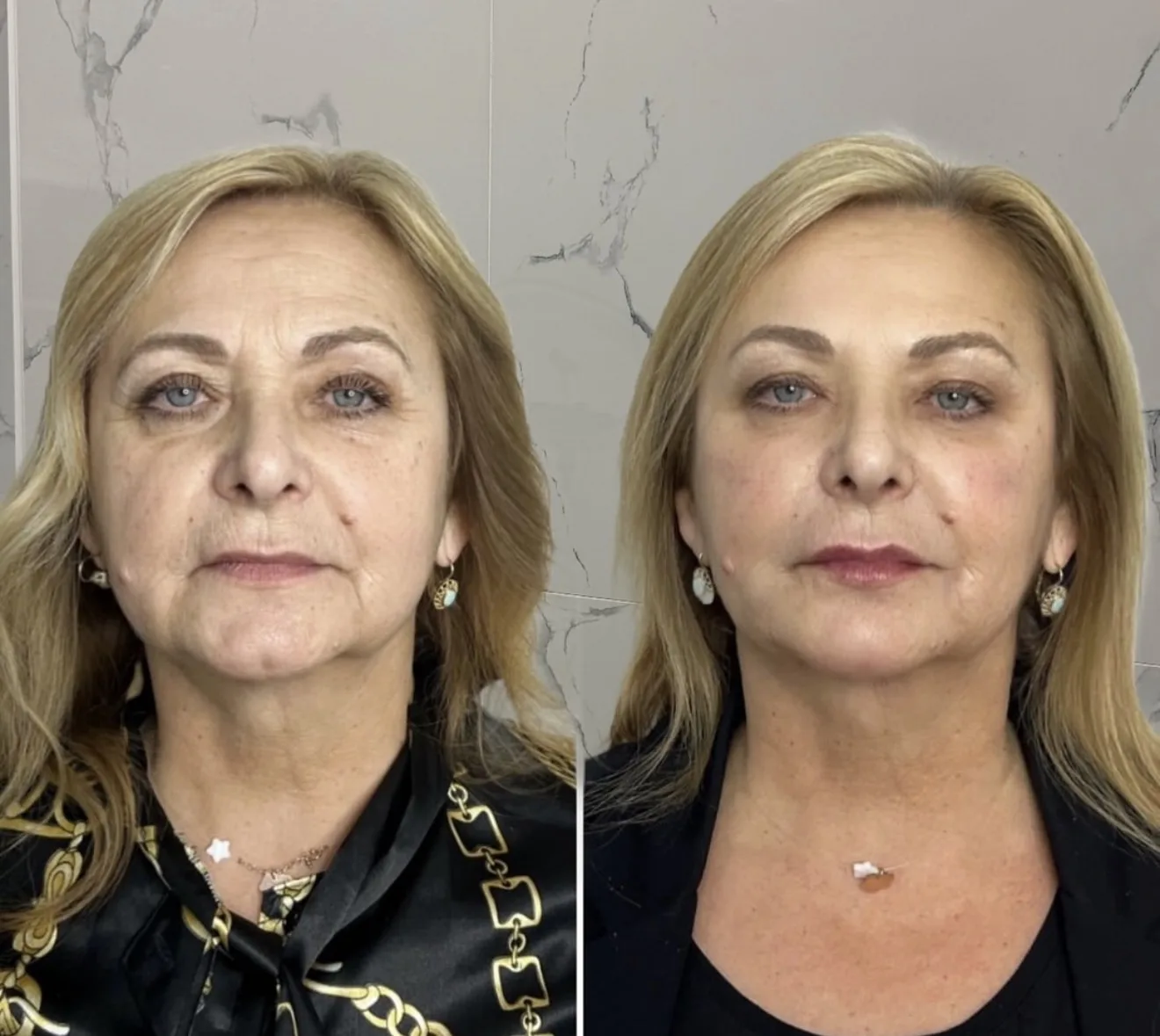 Девочки,здесь проведены 2 процедуры ❤️
