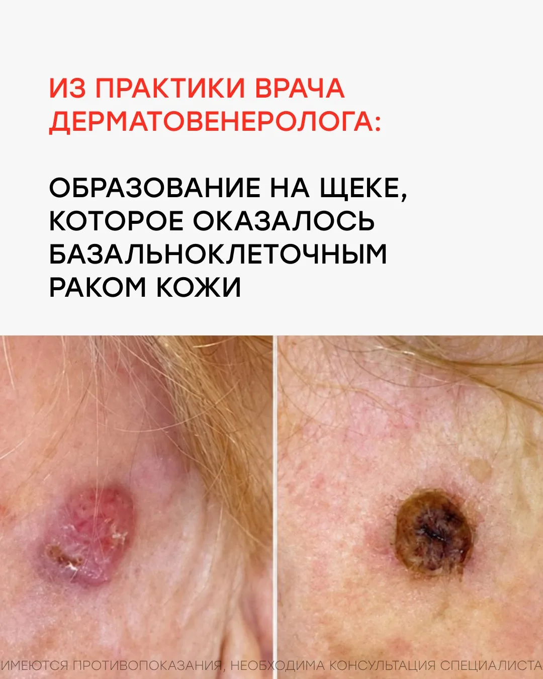 Недавно к нашему врачу-дерматовенерологу Анне Андреевне обратилась пациентка, 74 лет.