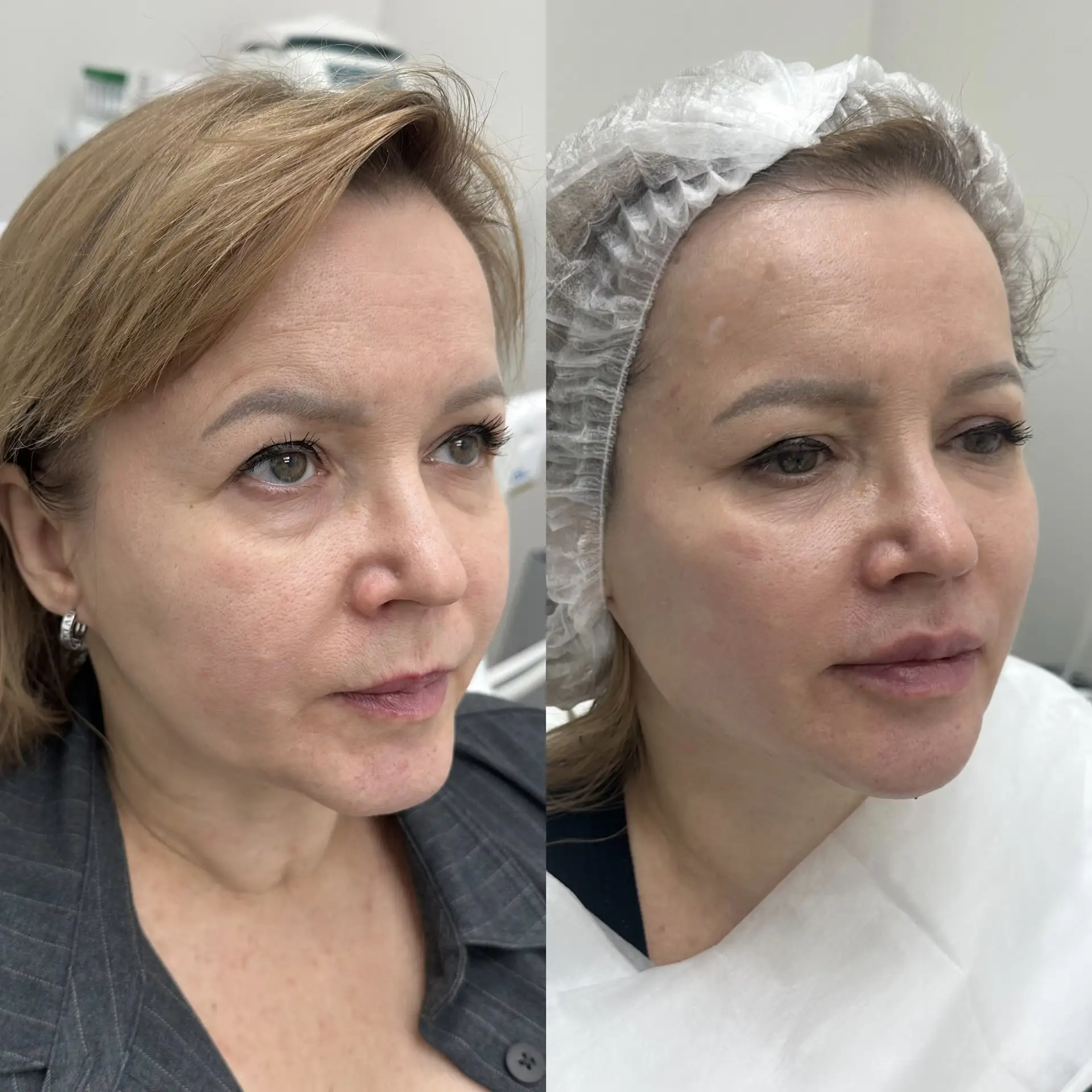 RADIESSE: тысячи процедур — одна любовь ✨
