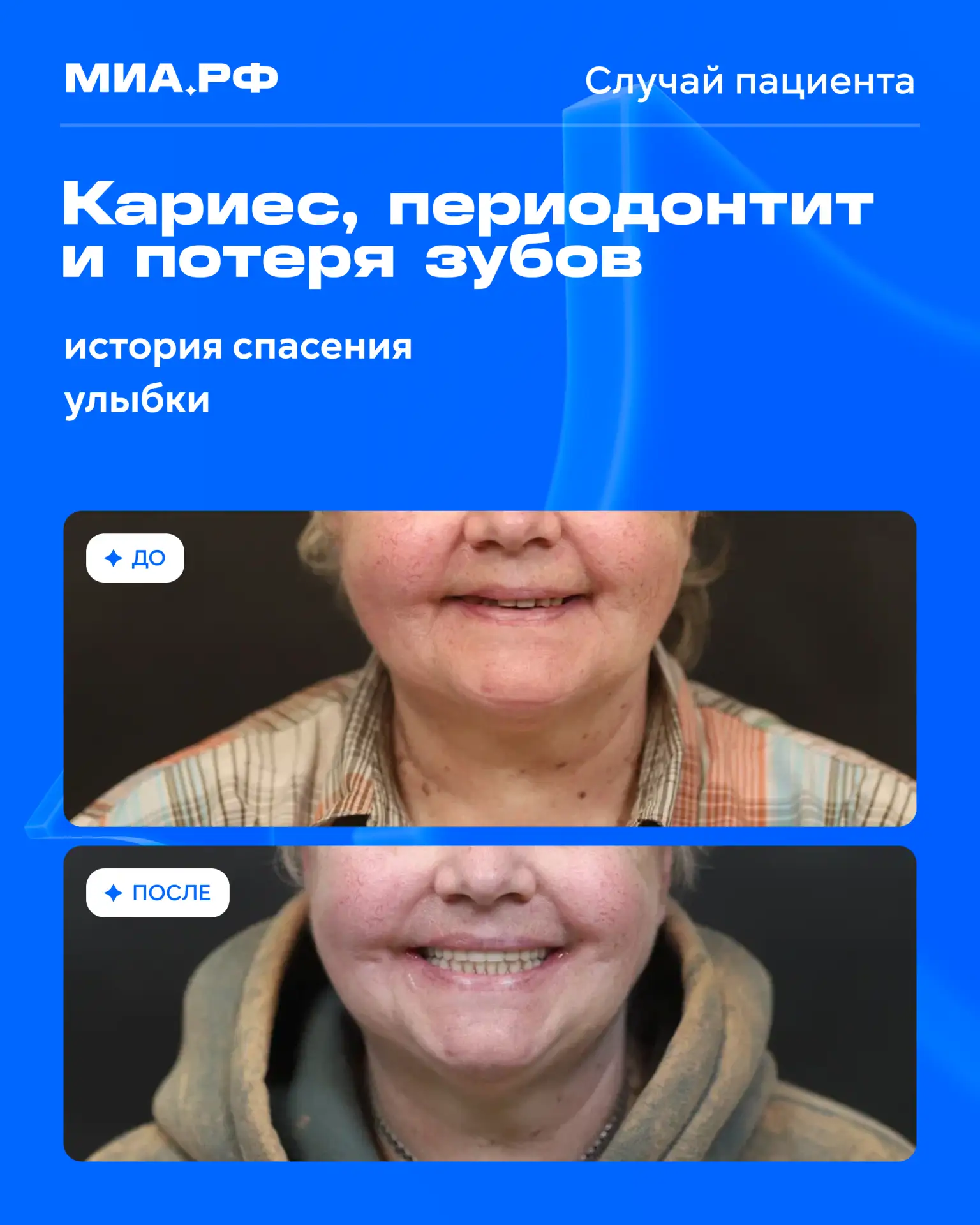Разбираем случай пациента: восстановили улыбку за 3 дня