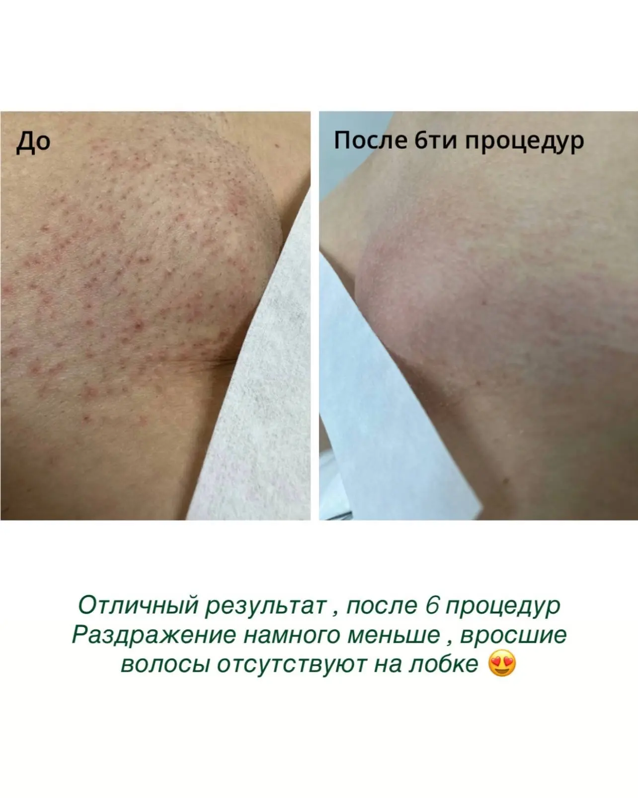 Начните прямо сейчас, и к лету вы уже забудете о бритве!

📌-20% на первое посещение 
📌-30% при пок