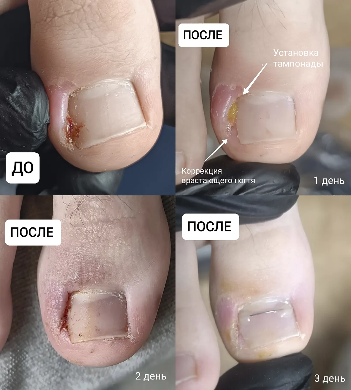 Динамика работы с вросшим ногтем 👣