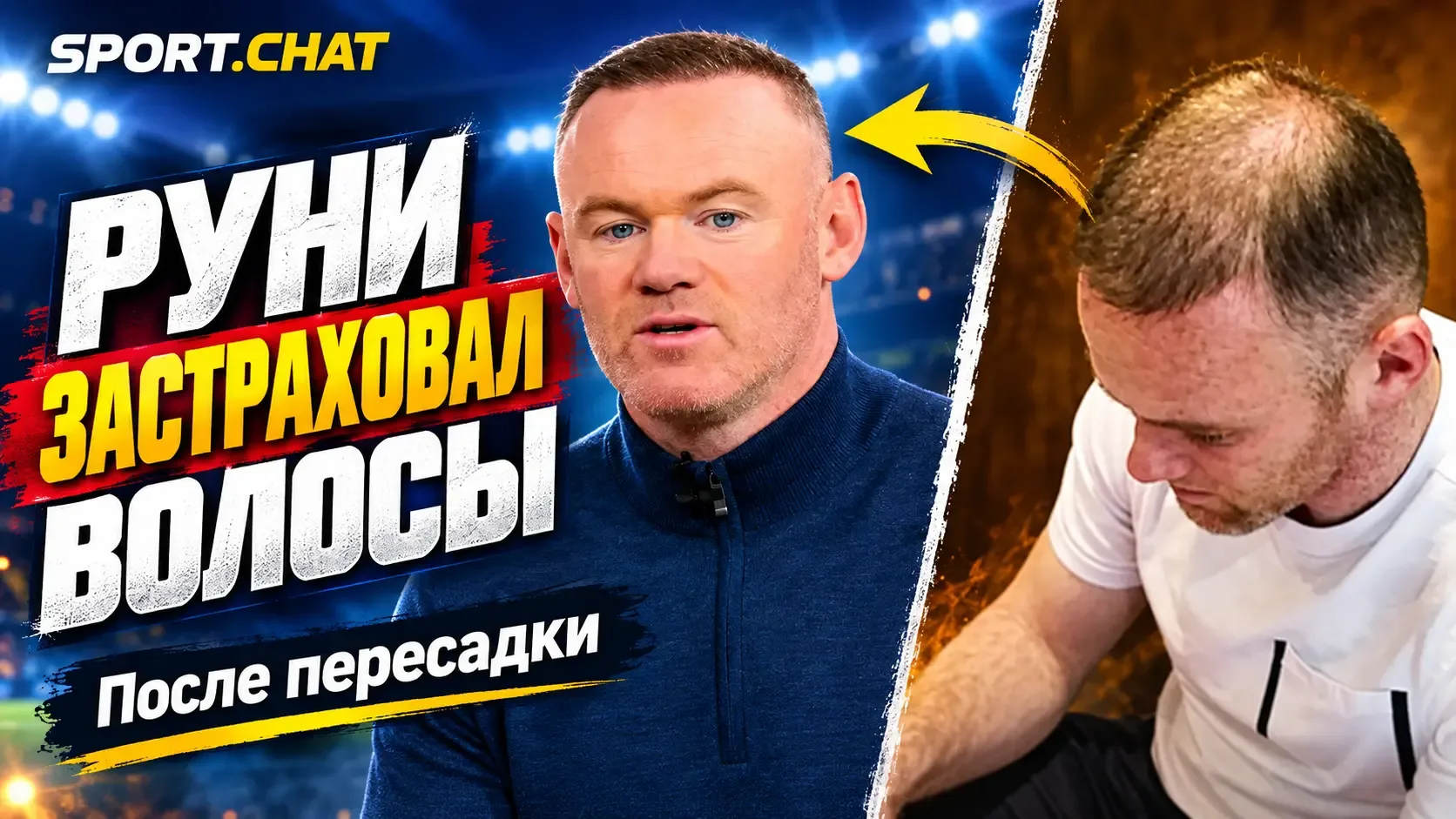 Уэйн Руни застраховал волосы после пересадки