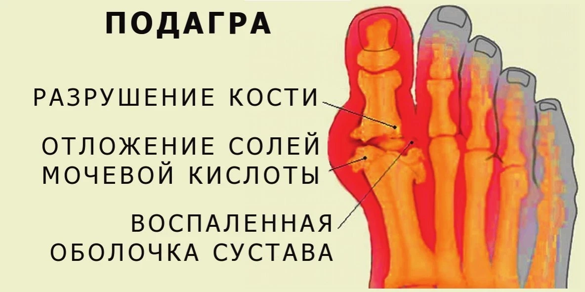 Подагра – это хроническое заболевание, которое возникает из-за нарушения обмена веществ...