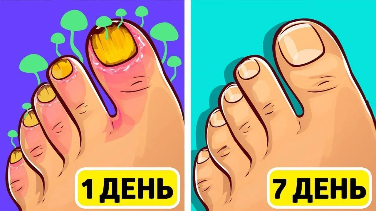 ГРИБОК НОГТЕЙ ЗАМУЧАЛ ДО СМЕРТИ?