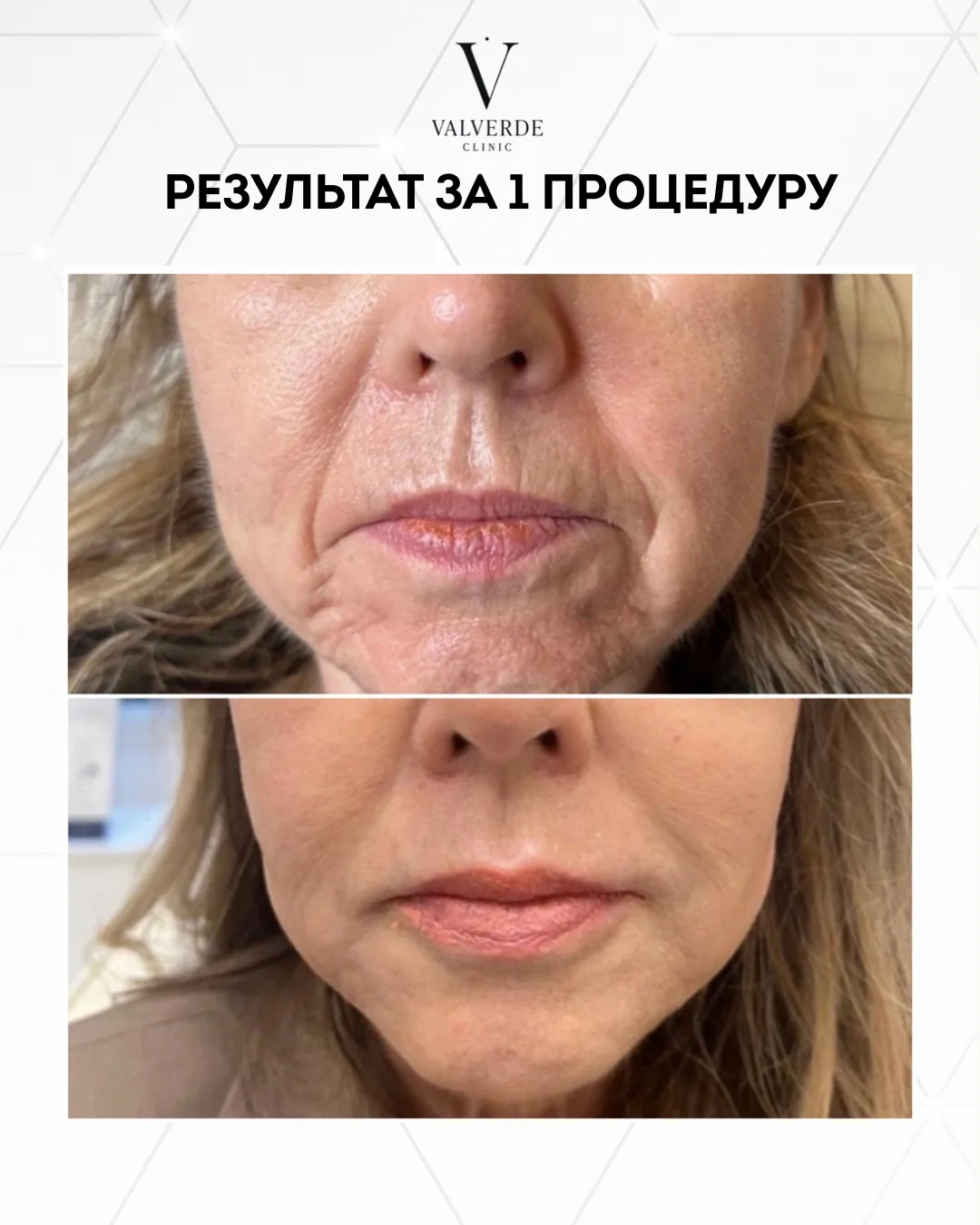 🌟 Вдохновляющие результаты после всего одной процедуры! 🌟