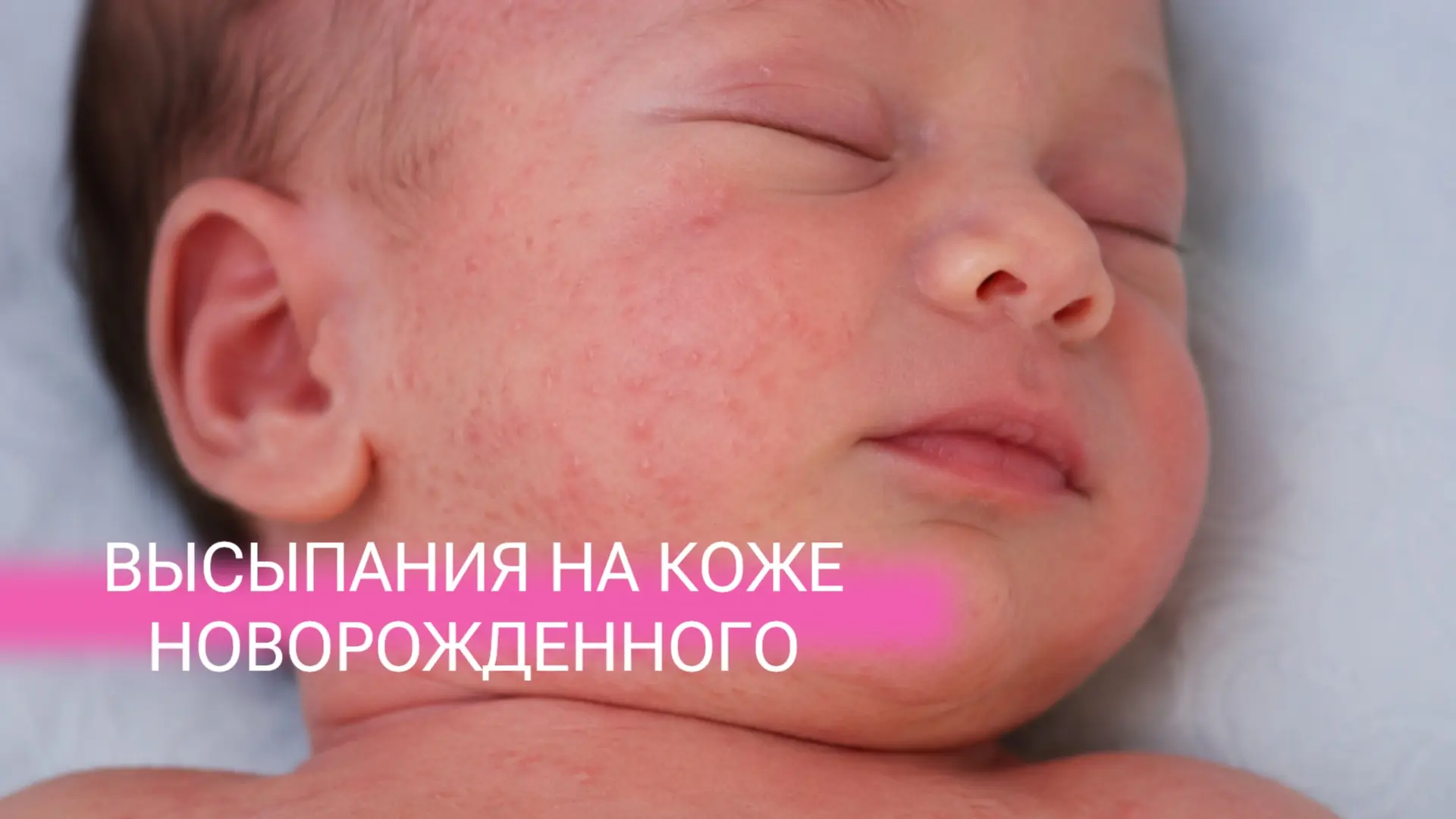👶 Высыпания на коже новорожденного: норма или патология?