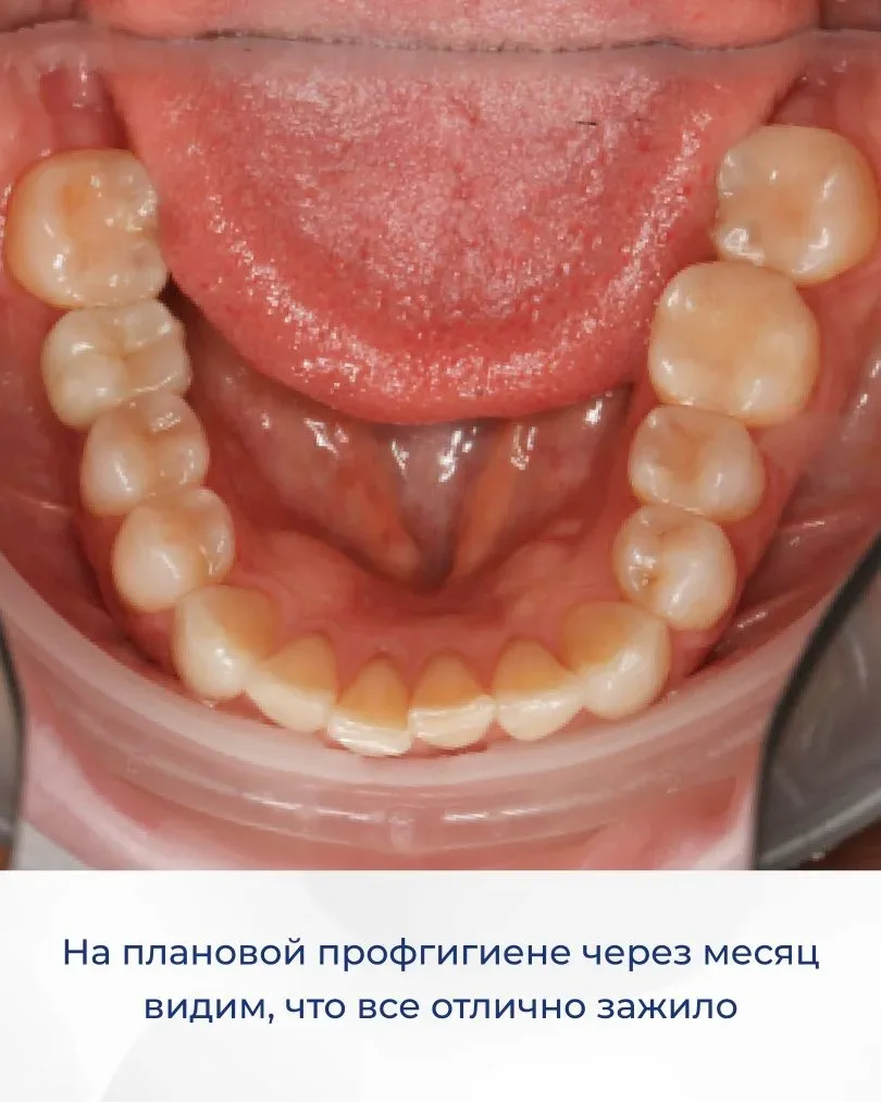 Сразу три зуба удалили пациентке всего за один прием. Это восьмые зубы. Они никак ее не беспокоили и