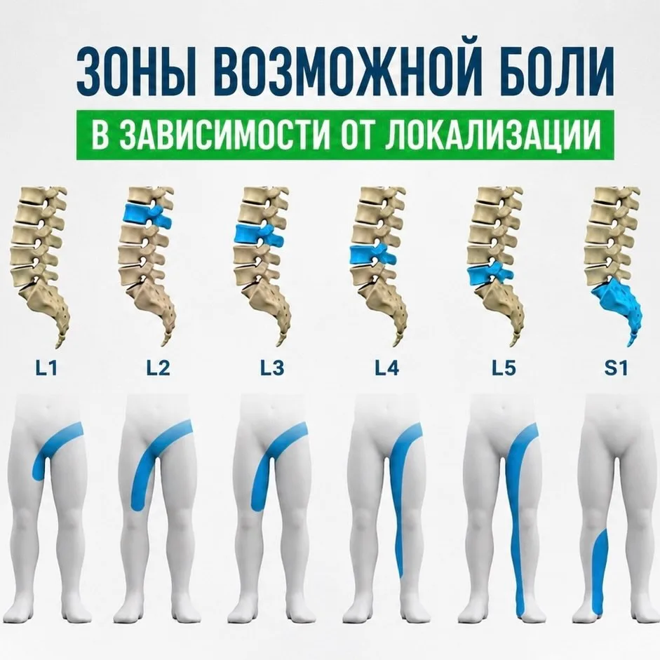 ⚡ Тянет ногу? Немеют пальцы? Боль спускается от поясницы вниз?

Часто причина находится не там, где 