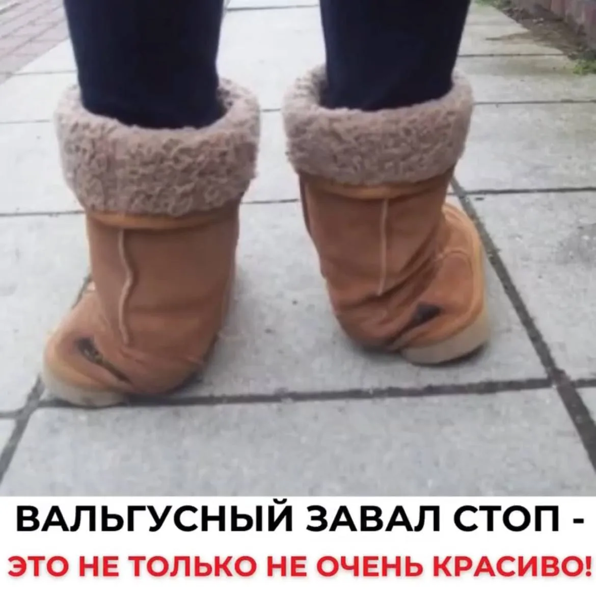 У моего ребенка завал стопы, и он начинает косолапить…  «Ну и что там такого, перерастает, просто он