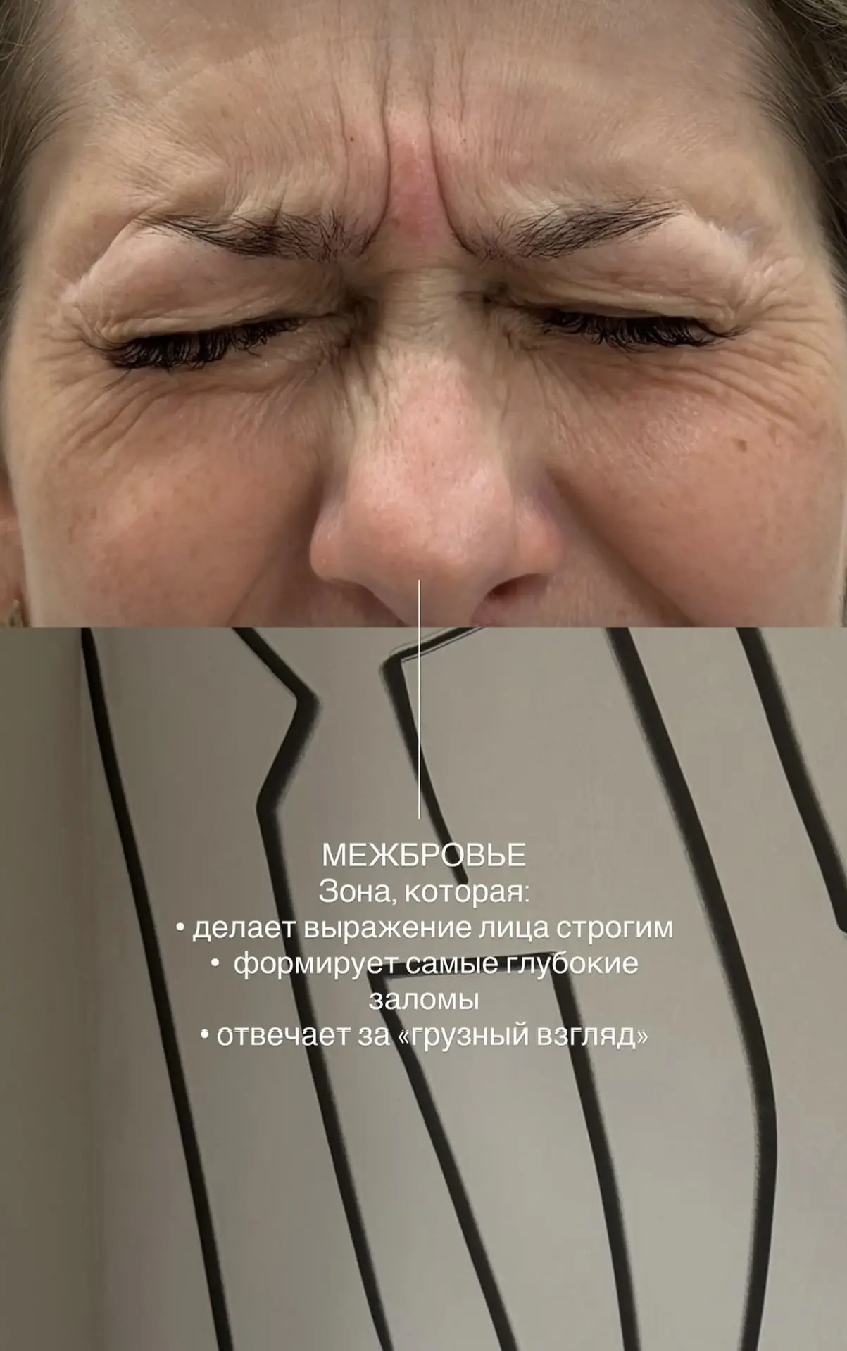 Ботулинотерапия 🪄