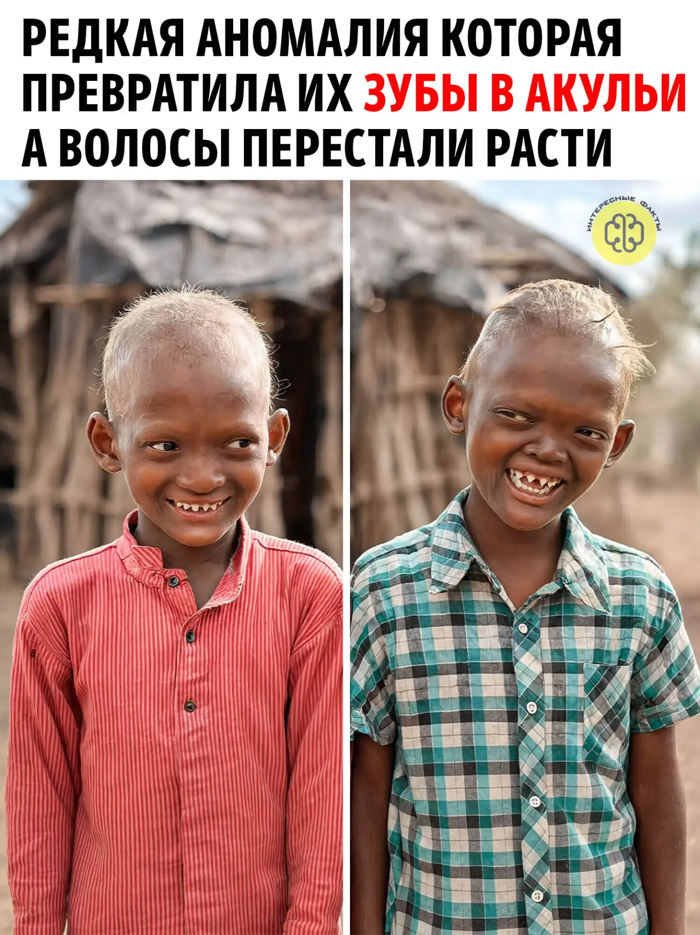 Два брата стали изгоями благодаря редкой аномалии, превратившей их зубы в акульи