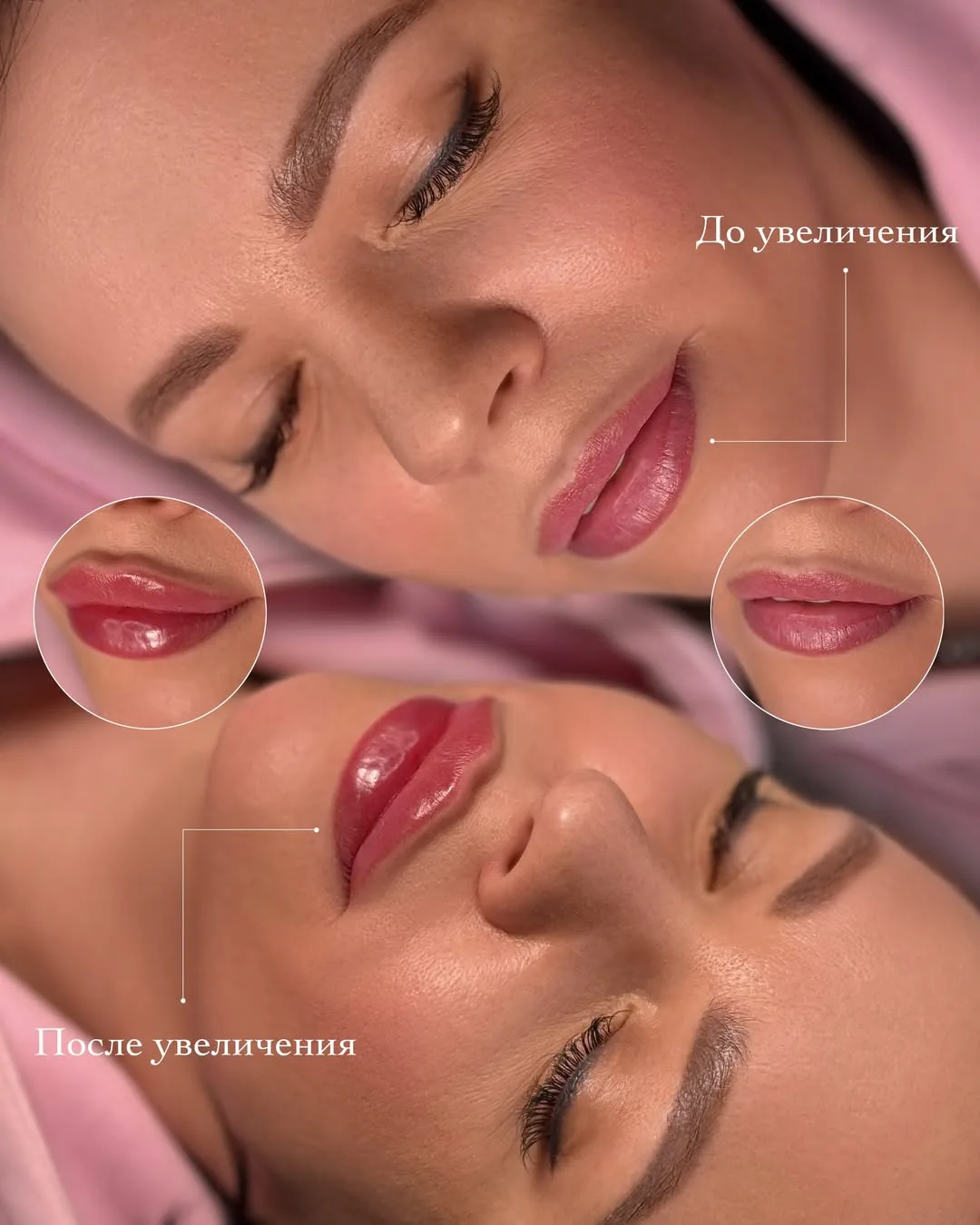 Губы после заживления: когда результат выглядит дорого ✨