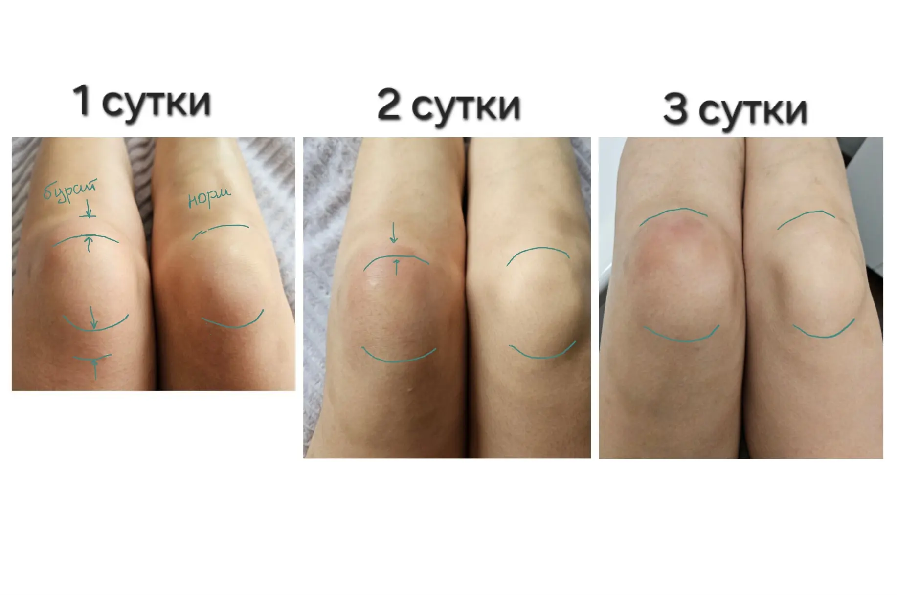 Бурсит коленного сустава