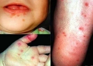 🦠 В Башкирии резко выросло число случаев энтеровирусной инфекции