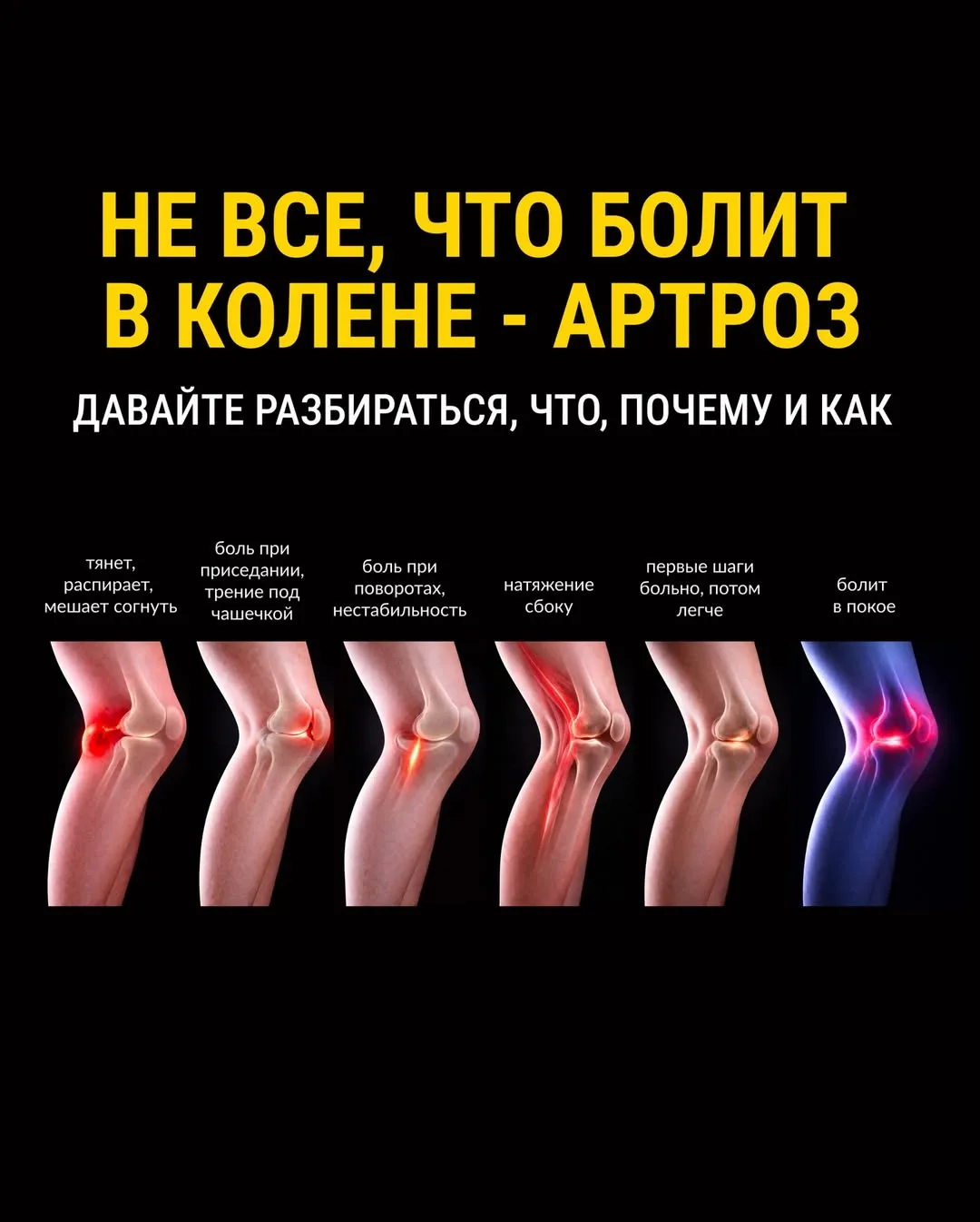 Болит колено - и вы думаете, что это артроз? Не спешите с выводами.

Боль в колене бывает разной: сп