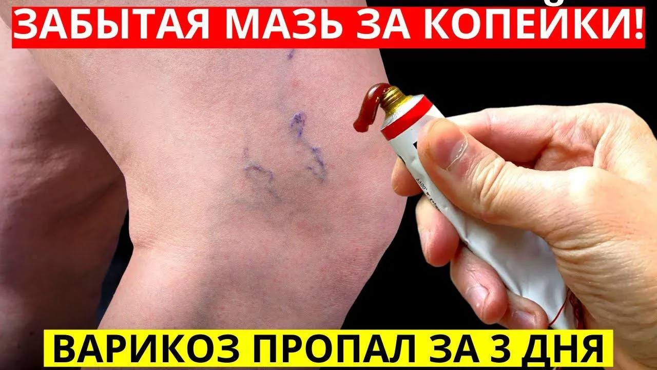 Варикоз уйдет НАВСЕГДА! Забытая советская мазь!