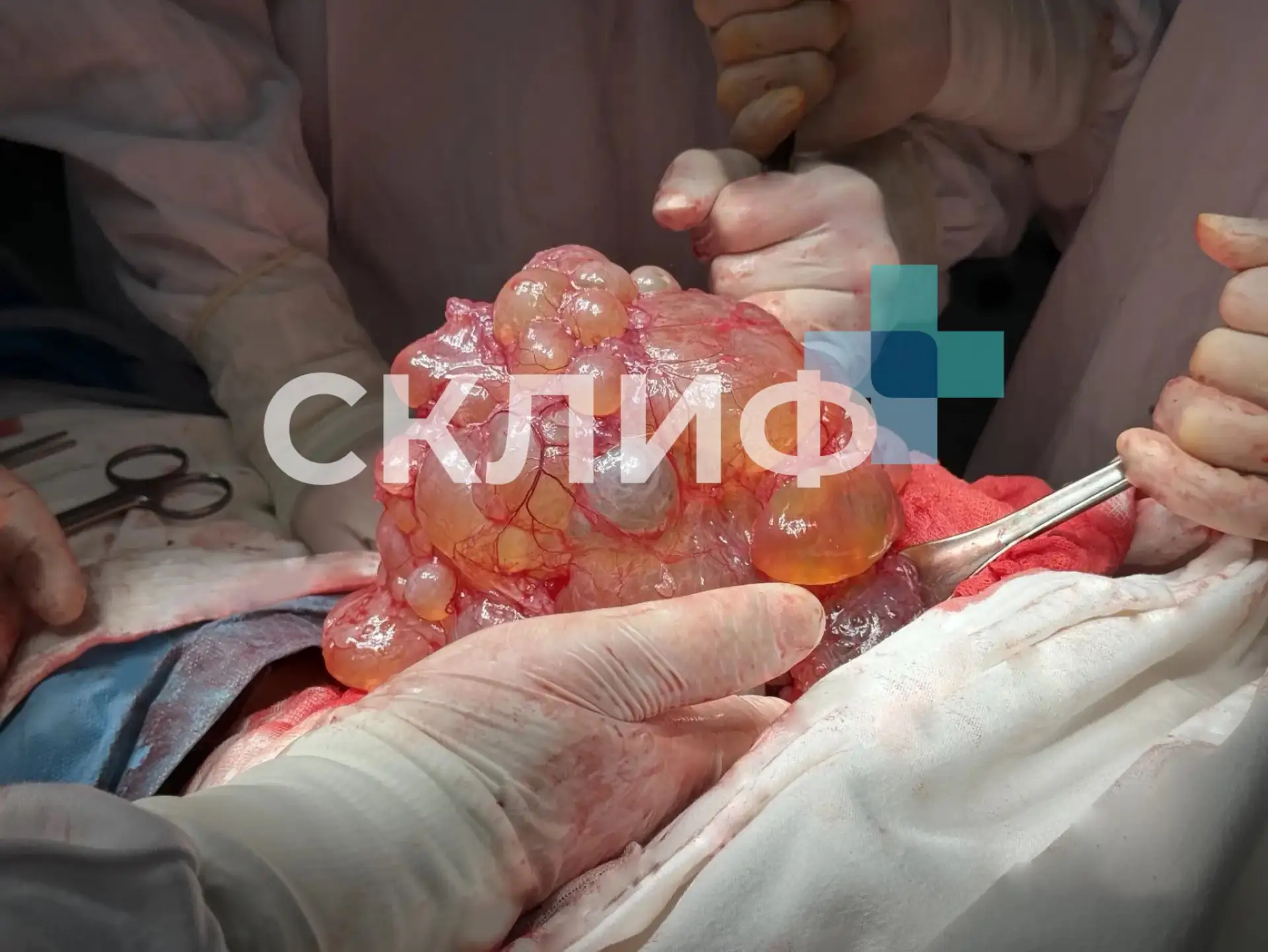 😱 Нет, это не кадры из фильма про инопланетян. Это образование удалили хирурги Склифа ...