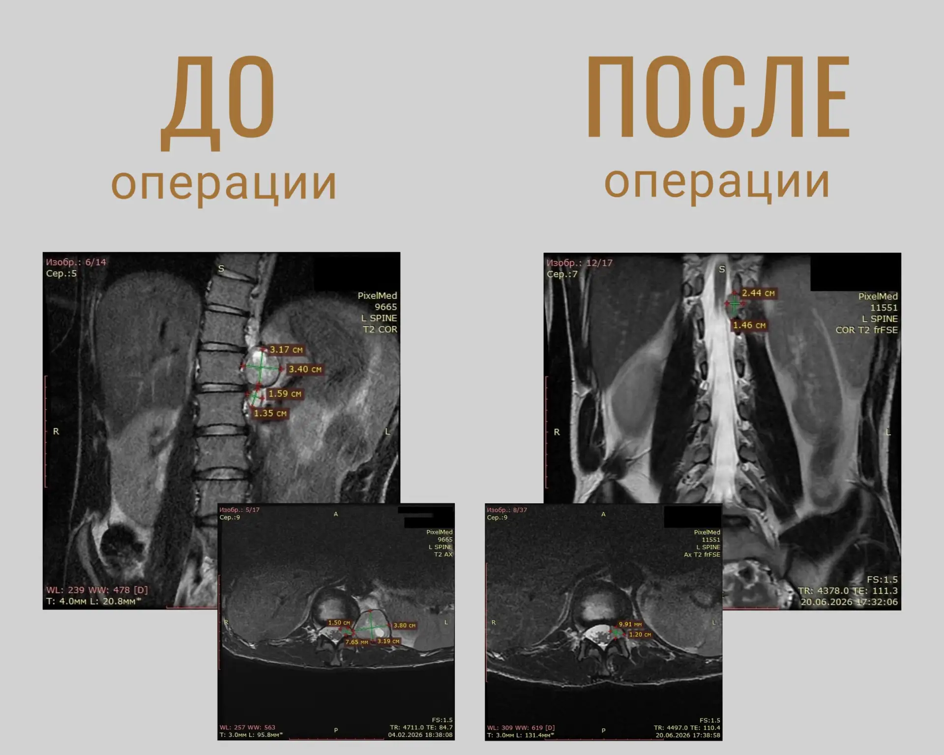 Опухоль спинного мозга с необычным расположением успешно удалена нейрохирургами Волгогр...