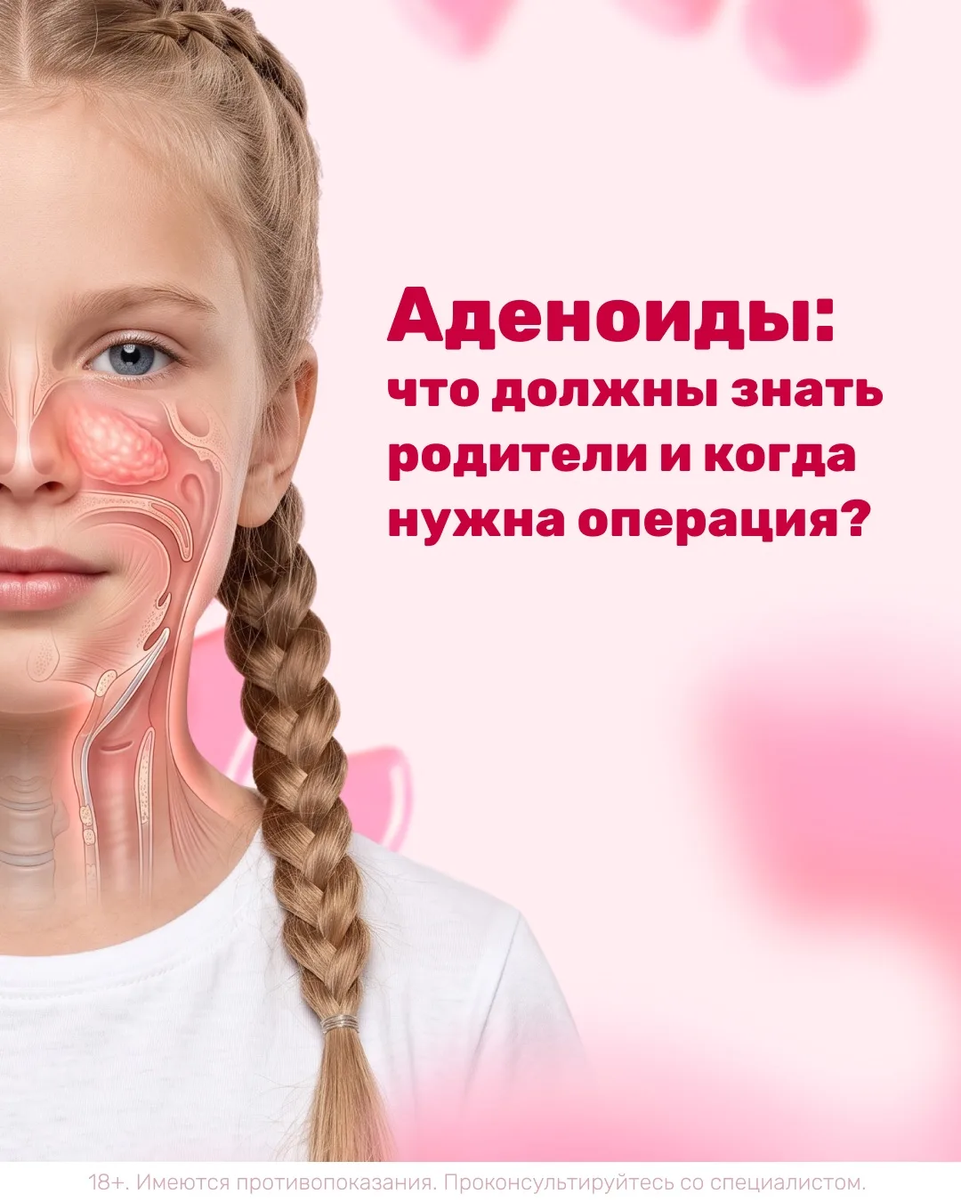 💬 Что такое аденоиды и нужна ли ребенку операция?
