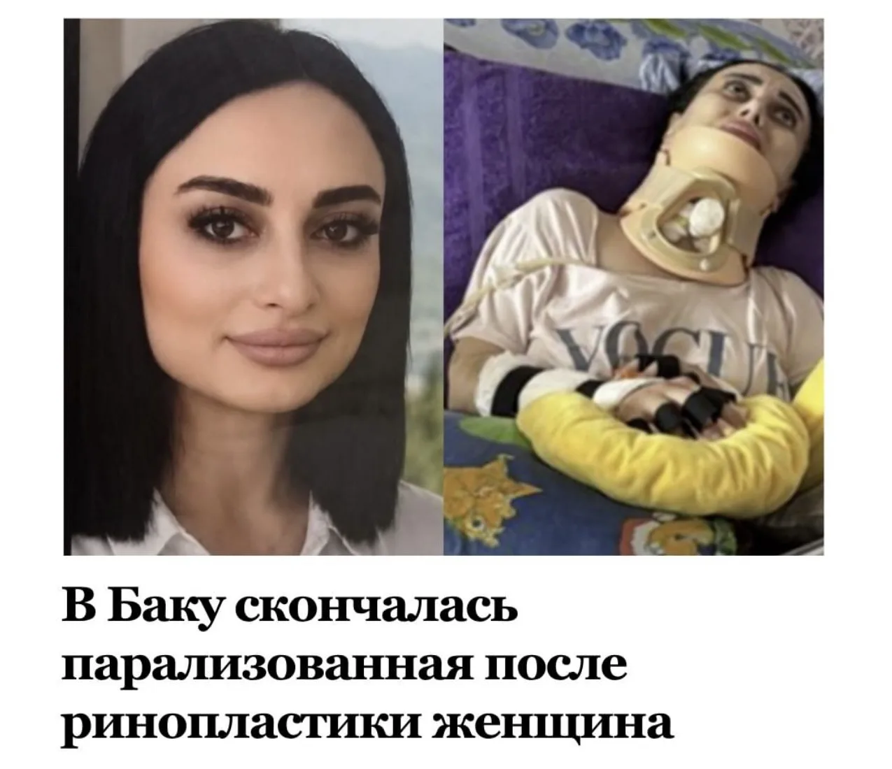 В Баку скончалась 34-летняя женщина, ставшая парализованной после ринопластики, проведе...