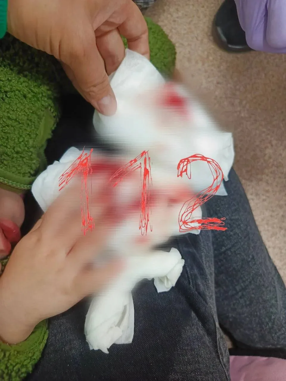 Двухлетней девочке потребовалась операция после того, как она прищемила пальцы дверью в...