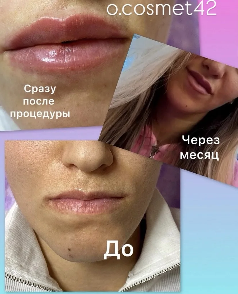 Сложные губы. Шрам на нижней губе и асимметрия верхней.