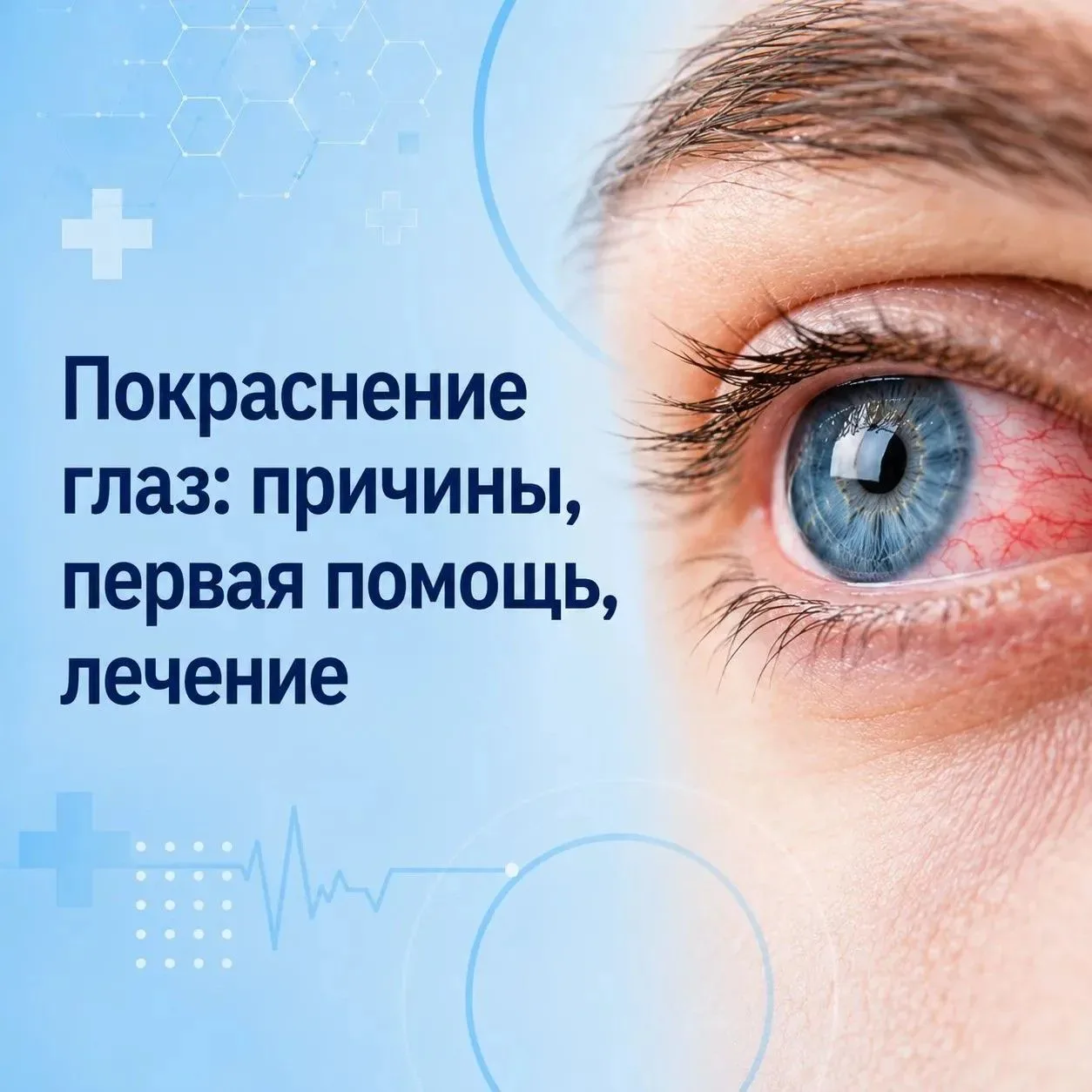 Покраснение глаз — сигнал организма, который не стоит оставлять без внимания. Нередко е...