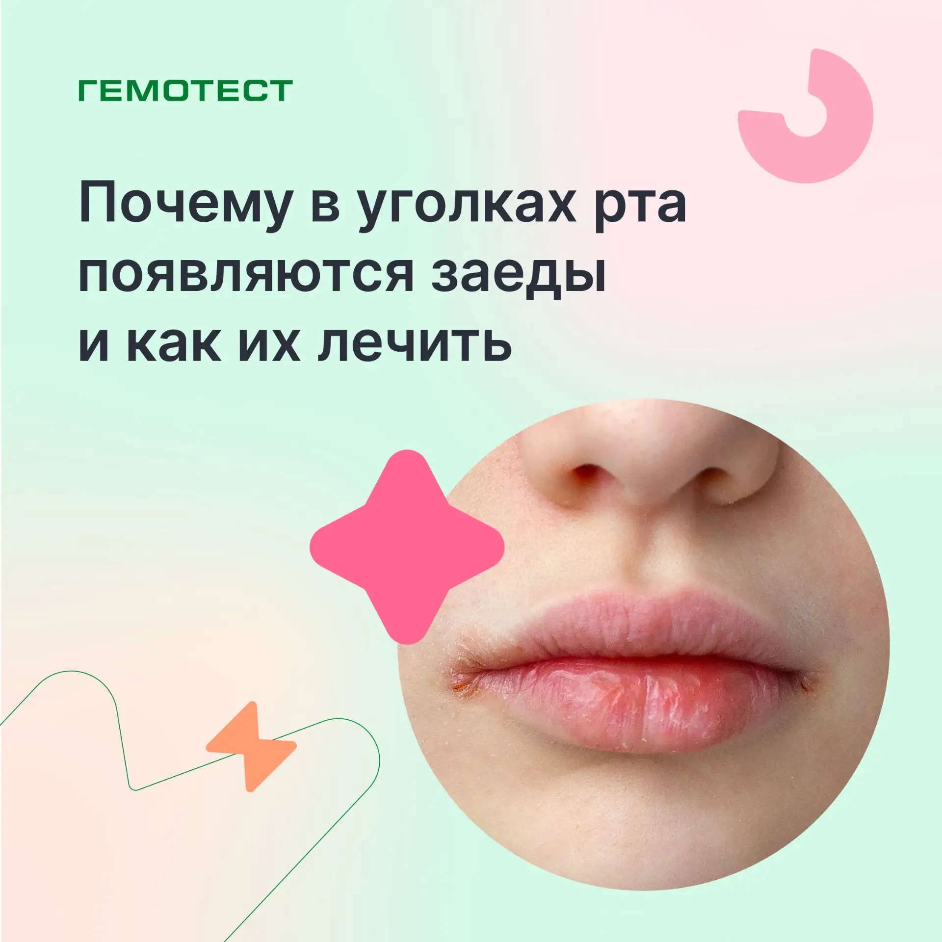Почему в уголках рта появляются заеды и как их лечить

Перекусывать и даже улыбаться бывает больно, 