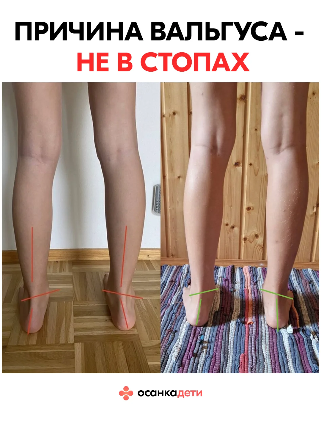 🤔Причины ВАЛЬГУСА не в стопах!