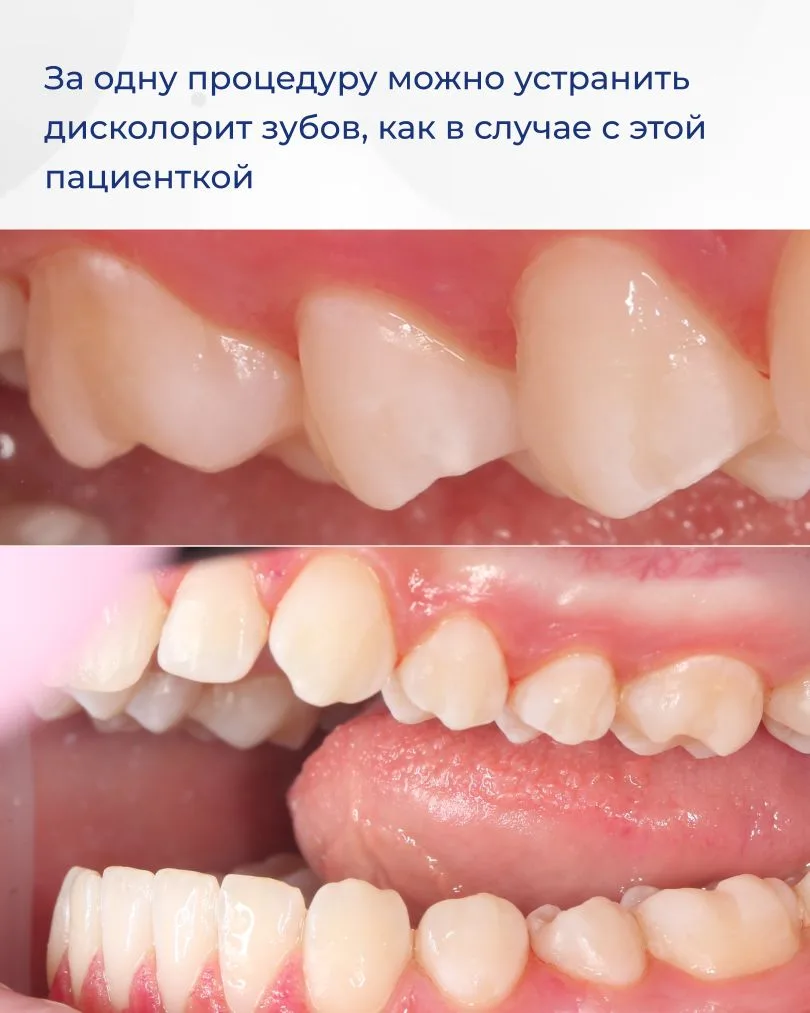 Устраняем дисколорит зубов за одну процедуру! Как это возможно? Сейчас расскажу! Пациентке 11 лет. Б