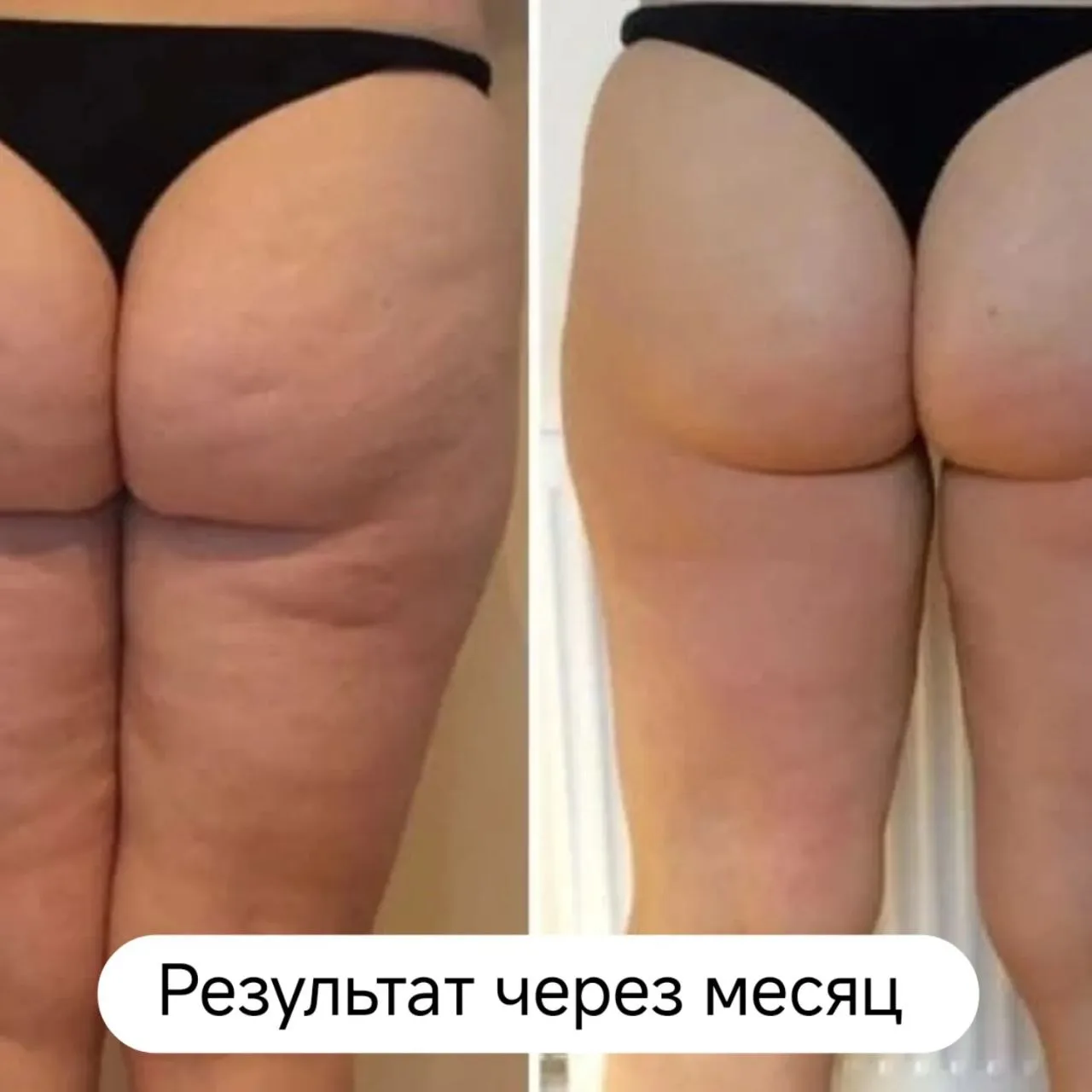 Вылепить упругие ягодицы и убрать «корку» за 1 процедуру? Это не фейк.