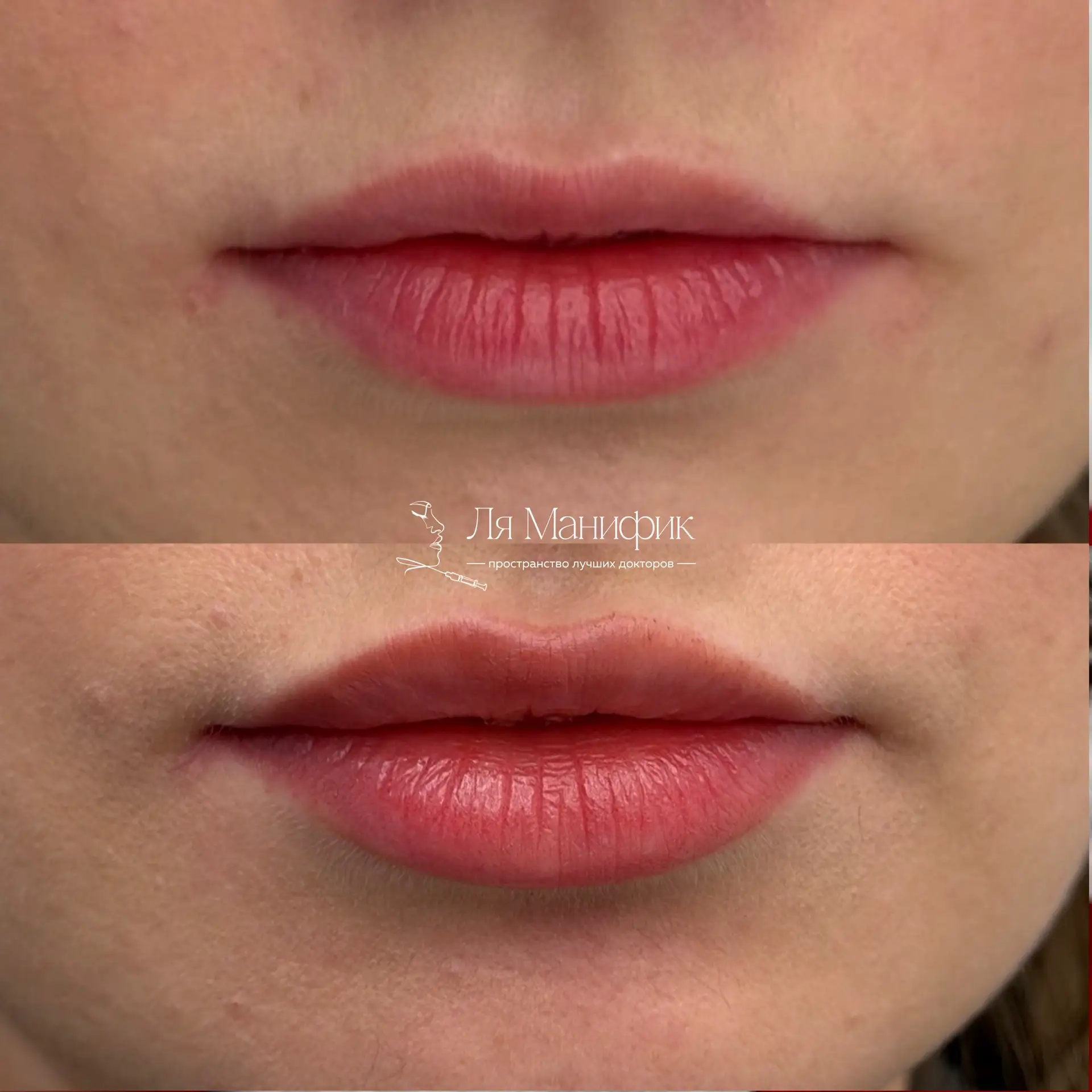 Почему 1 мл филлера в губах у всех выглядит по-разному? 💋