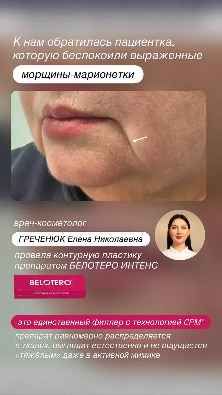 МИНУС МОРЩИНЫ-МАРИОНЕТКИ ЗА 1 ПРОЦЕДУРУ 🔥