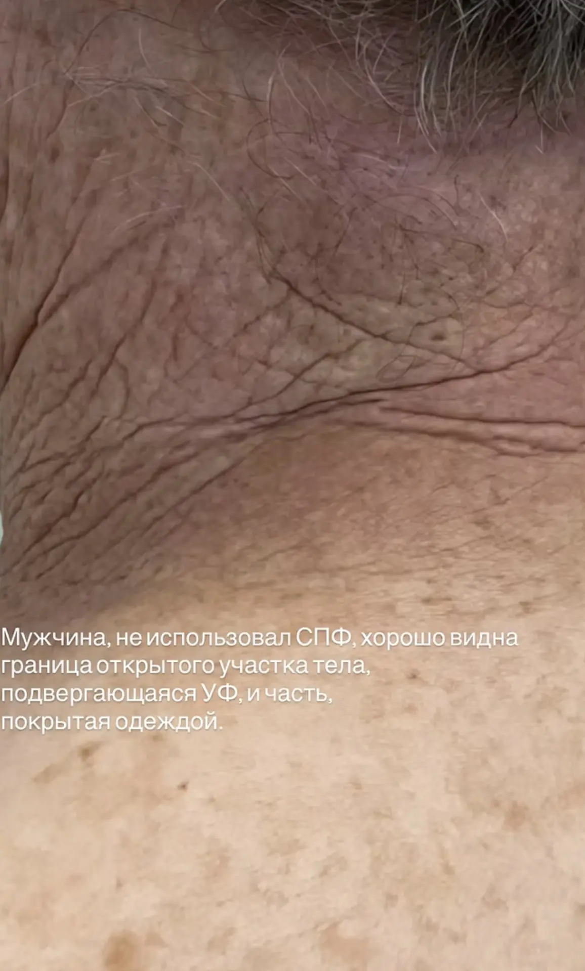 Солнечные лучи ускоряют старение! 

Мы уже писали пост про СПФ в начале летнего сезона и делаем это 